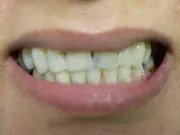 dacosta_crown_and_bridge_-_2d_04