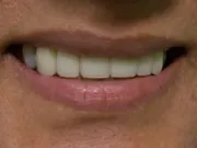 dacosta_crown_and_bridge_-_2g_06